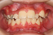 写真：治療前の歯列
