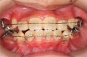 写真：治療中の歯列