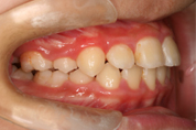 写真：治療後の歯列